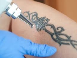 I don't like the look of being completely bald down there so i decided to leave a thin line of hair. Will Laser Hair Removal Affect My Tattoo Local Skin Therapies