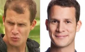 Daniel Tosh Balding Before Hair Transplant Hair Transplant Results Hair Transplant Celebrity Hairstyles