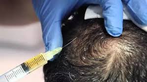 Hair loss affects men and women of all ages and ethnicities. What Is The Cost Of A Prp Hair Loss Treatment At Oliva In Hyderabad Quora
