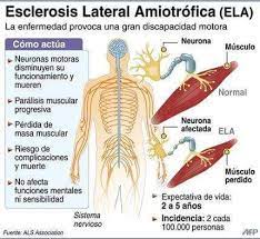 La esclerosis lateral amiotrófica afecta, tanto la primera como la segunda motoneurona que se ocupan de inervar los músculos voluntarios. Guias Sobre Esclerosis Lateral Amiotrofica Ela Esclerosis Lateral Amiotrofica Esclerosis Cuidados De Enfermeria