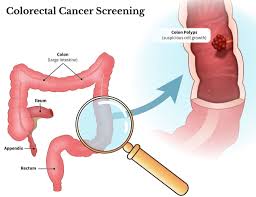Image result for Colon Cancer Screening with Colonoscopy