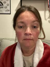 Is brazilian waxing safe with lupus?