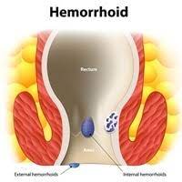 They become a disease when swollen or inflamed; Epidemiology Of Hemorrhoids