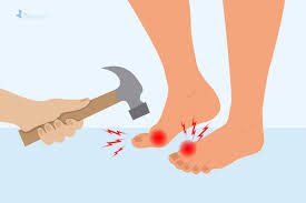 Image result for gout symptoms toe