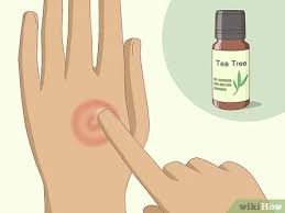 Tinea corporis (ringworm) is a fungal infection of the skin generally characterized (intially) by a red raised round patch, followed by. How To Get Rid Of Ringworm Can Natural Remedies Help