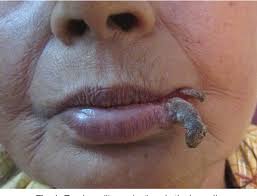 Image result for cornu cutaneum)