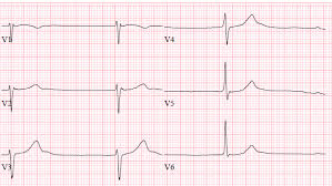 Wide or deep q waves may indicate: The Ekg Guy How Many Leads Below Have Pathological Q Waves Facebook