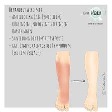 Image result for erysipel photos)