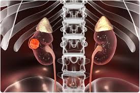 Kidney cancer happens when healthy cells in one or both kidneys grow out of control and kidney cancer rarely causes signs or symptoms in its early stages, but larger ones might. Renal Cell Carcinoma Survival Rate
