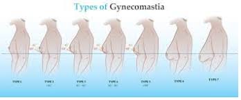 health about what is gynecomastia