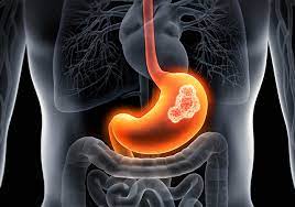 The swelling is due to a build up of fluid called ascites. Can I Have Stomach Cancer And Not Know It Health News University Of Miami Hospitals And Clinics