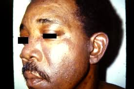 Image result for Photodermatitis