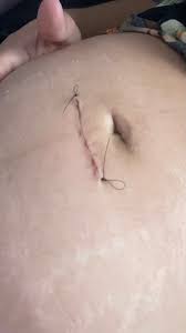 Laqueadura SUS | BabyCenter