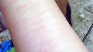 We did not find results for: Aksi Silet Tangan Anak Sd Menular Satu Sekolah Berawal Dari Siswa Kelas Vi Puluhan Lain Terluka Tribun Bali