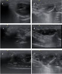 However, an anechoic bilateral pleff would suggest a transudate. A Pleural Effusion Model In Rats By Intratracheal Instillation Of Polyacrylate Nanosilica Protocol