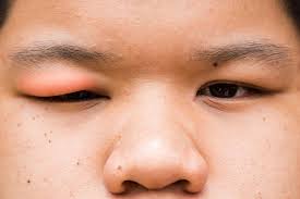 Comment removed by moderator 3 years ago more than 1 child. Sore Eyelid Causes When To See A Doctor And Treatment