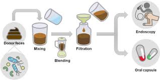 Image result for Fecal Transfer