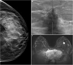 Breast cancer type and stage: Breast Cancer Staging Combined Digital Breast Tomosynthesis And Automated Breast Ultrasound Versus Magnetic Resonance Imaging European Journal Of Radiology
