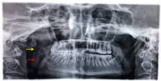 Metastatic breast cancer is the most advanced stage (stage iv) of breast cancer. Metastatic Breast Carcinoma To Mandible A Case Report