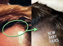 Partially for this reason, there are derma rollers of various sizes. Ingredients Derma Roller Use 1 5mm Lavender Oil Directions Comb Your Hair Use A Hairband To Pull Al Regrow Temple Hair Regrow Hair Naturally Temple Hair Loss
