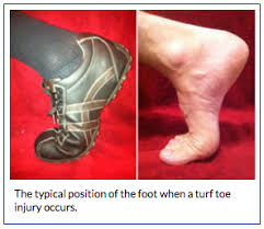 Turf toe is a sprain of the big toe joint resulting from injury during sports activities. Anatomy Of Turf Toe Bouldercentre For Orthopedics Spine