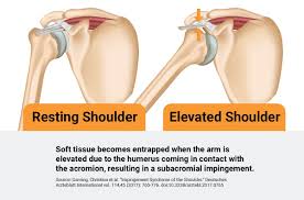 Sleeping With Shoulder Impingement Rotator Cuff Injury Medcline