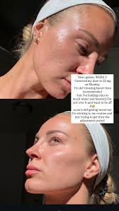 Coming Off Spironolactone