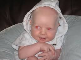 404 Not Found Albinism Pale Beauty Albino