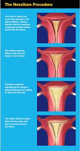 Novasure Endometrial Ablation Fibroids Ablation Surgery