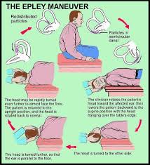 Benign Paroxysmal Positional Vertigo Bppv Epley Maneuver Vertigo Treatment Vertigo Exercises