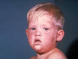 Image result for measles