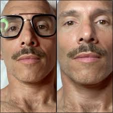 EpiPin Needle-Free Needling w 3D-lized Hyaluronic Micro Pins