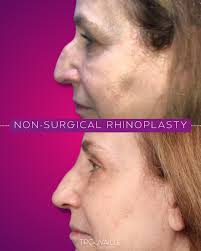 Refined without surgery 👃🏼 See the power of a non-surgical rhinoplasty  performed by Houston board-certified plastic surgeon Dr. Michelle Steinberg.  Using precise filler placement, Dr. Steinberg can smooth bumps, refine the  profile,