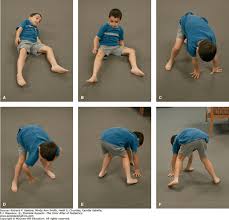 Image result for Muscular Dystrophy
