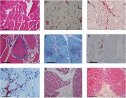 Image result for Myopathy