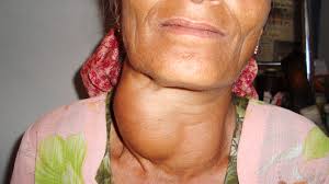 Content of chemical elements and their ratios are close to optimum phaerozems, chernozems and kastanozems. Goiter Causes Types And Treatment