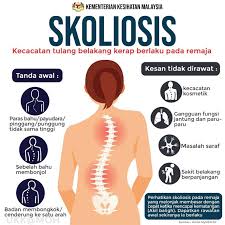 We did not find results for: Skoliosis Jika Dikesan Di Tahap Awal Masih Ada Harapan Untuk Disekat