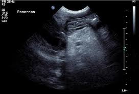 Depending on the gene, an individual needs to possess both mutated copies or just one. Shwachman Diamond Syndrome Radiology Case Radiopaedia Org