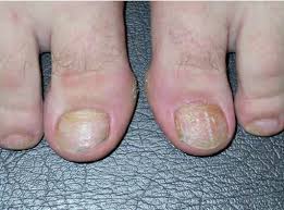 Image result for Pitting nails feet