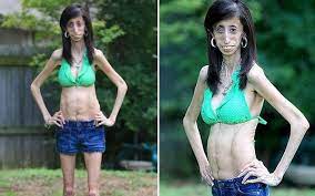 Check spelling or type a new query. 7 Ñ•yrrsyat Ideas Lizzie Velasquez Velasquez Skinny