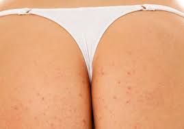 Common pimples should not concern you a great deal, if they resolve easily. Pimples On Buttocks How To Get Rid Of Them Best Acne Spot Treatment Http Www Healthacnetreatment Com