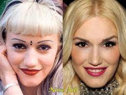 Shelton is reportedly quite unhappy with stefani's changing looks and love of plastic surgery. Gwen Stefani Before After Plastic Surgery Nose Job Nose Job Plastic Surgery Celebrity Plastic Surgery