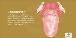 Check spelling or type a new query. Lidah Geografik Tanda Dan Gejala Penyebab Cara Mengobati Cara Mencegah