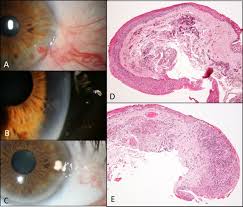 Maybe you would like to learn more about one of these? Pyogenic Granuloma Associated With Conjunctival Epithelial Neoplasia Report Of Nine Cases British Journal Of Ophthalmology