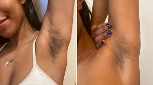 Dark, velvety patches on the neck, underarms, or skin folds can feel frustrating - and many people try bleaching creams, only to be disappointed. That's because with Acanthosis Nigricans, the solution isn't