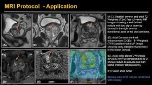 The earlier the detection of prostate cancer, the better the patient's chance of survival is. Epos Trade