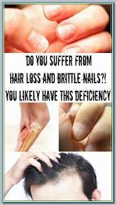 Rogaine is consistently safe in men and can cure hair loss over 50% of cases (1). The Ingredients Within The Prescription Can Cause Your Hair To Fall Out Browse More By Visiting Biotin For Hair Loss Prp Hair Loss Treatment Hair Loss Cure