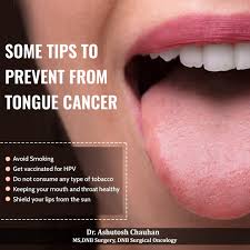 Image result for cancer of tongue