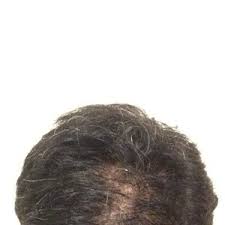 Smoking can make you age faster, making hair go gray earlier than 30 years of age and causing skin to wrinkle. Correlation Between Premature Hair Greying Scalp Widening And Masturbation Photo
