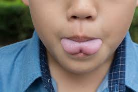 Image result for Ankyloglossia
